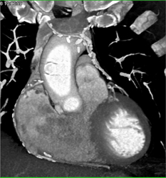 Patent Bypass Graft - CTisus CT Scan