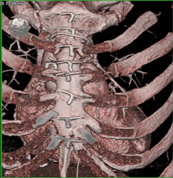 Patent Bypass Graft - CTisus CT Scan