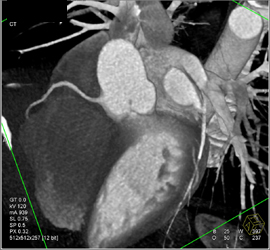 Normal Coronary Arteries - CTisus CT Scan