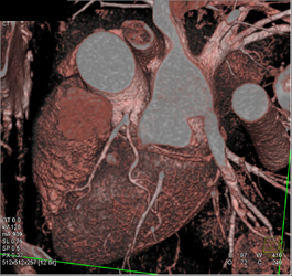 Normal Coronary Arteries - CTisus CT Scan