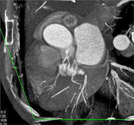 Normal Coronary Arteries - CTisus CT Scan