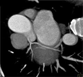 Normal Coronary Arteries - CTisus CT Scan