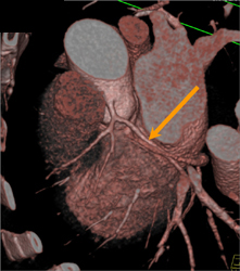 Normal Coronary Arteries - CTisus CT Scan