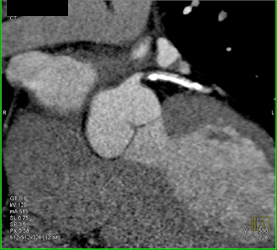 Soft and Calcified Plaque - CTisus CT Scan