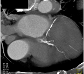 Extensive Calcifications in LAD and Circumflex Artery (CX) - CTisus CT Scan