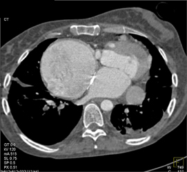 Dilated Right Atrium - CTisus CT Scan