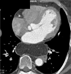 Huge Hiatal Hernia - CTisus CT Scan