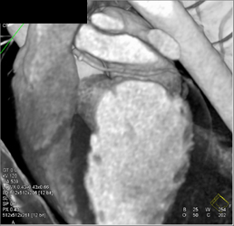 Normal Coronary Arteries - CTisus CT Scan