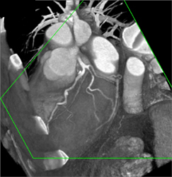 Normal Coronary Arteries - CTisus CT Scan