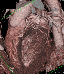 Normal Coronary Arteries - CTisus CT Scan