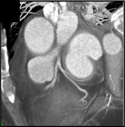 Normal Coronary Arteries - CTisus CT Scan