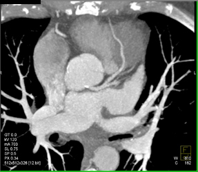 Normal Coronary Arteries - CTisus CT Scan