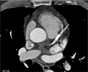 Patent LAD Stent - CTisus CT Scan