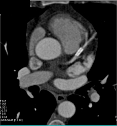 Patent LAD Stent - CTisus CT Scan