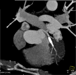 Patent LAD Stent - CTisus CT Scan