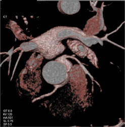 Patent LAD Stent - CTisus CT Scan