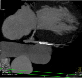 Patent LAD Stent - CTisus CT Scan