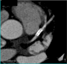 Patent LAD Stent - CTisus CT Scan