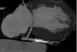 Patent LAD Stent - CTisus CT Scan