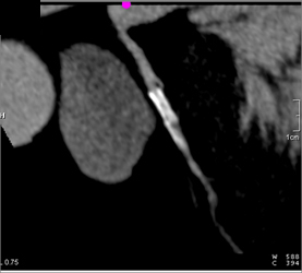 Patent LAD Stent - CTisus CT Scan