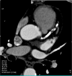 LAD Stenosis - CTisus CT Scan