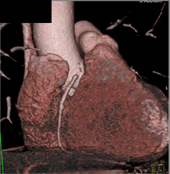 Diseased RCA - CTisus CT Scan