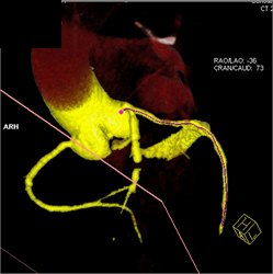 Extensive LAD Disease With Soft Plaque and Calcified Plaque - CTisus CT Scan