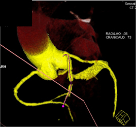 Occluded LAD With Soft Plaque - CTisus CT Scan