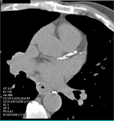 Extensive Calcified LAD - CTisus CT Scan