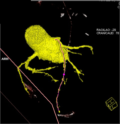 Diseased LAD - CTisus CT Scan