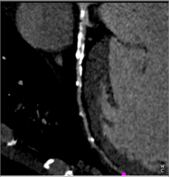 Diseased LAD - CTisus CT Scan