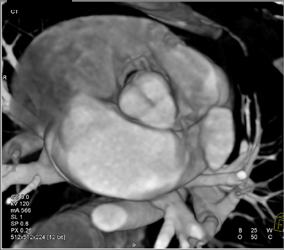 Normal Aortic Valve - CTisus CT Scan