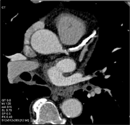 Diseased LAD - CTisus CT Scan