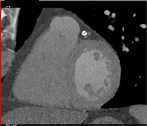 Diseased LAD - CTisus CT Scan