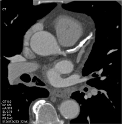 Diseased LAD - CTisus CT Scan