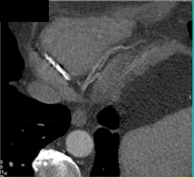 Diseased LAD - CTisus CT Scan