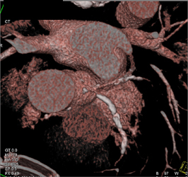 Diseased LAD and Circumflex Artery (CX) With Extensive Calcification - CTisus CT Scan