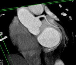 Normal LAD - CTisus CT Scan