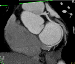 Normal LAD - CTisus CT Scan