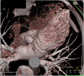 Normal RCA - CTisus CT Scan