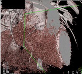 Normal RCA - CTisus CT Scan