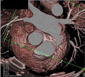 Normal LAD - CTisus CT Scan