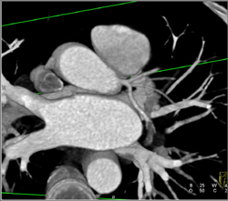 Normal LAD - CTisus CT Scan