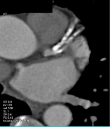 Diseased LAD - CTisus CT Scan