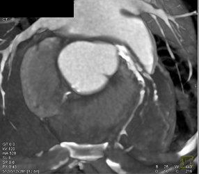 Diseased LAD - CTisus CT Scan