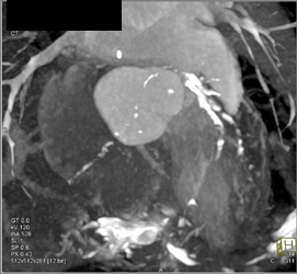 Diseased LAD - CTisus CT Scan