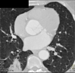 Incidental Right Lower Lobe Carcinoma - CTisus CT Scan