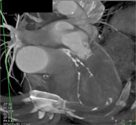 Severe LAD - CTisus CT Scan