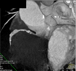 Dilatation of RCA - CTisus CT Scan