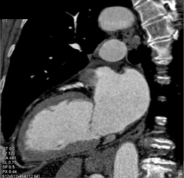 Diseased LAD - CTisus CT Scan